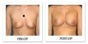 phoca_thumb_l_hsu-breast-augmentation-007