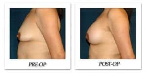 phoca_thumb_l_hsu-breast-augmentation-012