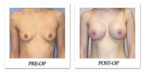phoca_thumb_l_mandris-breast-augmentation-001