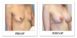 phoca_thumb_l_mandris-breast-augmentation-002