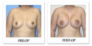 phoca_thumb_l_mandris-breast-augmentation-003