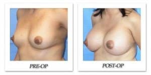 phoca_thumb_l_mandris-breast-augmentation-008