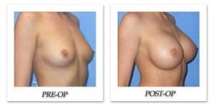 phoca_thumb_l_mandris-breast-augmentation-010