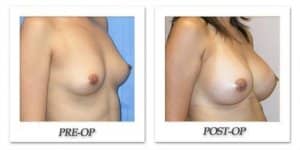 phoca_thumb_l_mandris-breast-augmentation-012