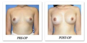 phoca_thumb_l_mandris-breast-augmentation-013