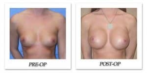 phoca_thumb_l_mandris-breast-augmentation-015