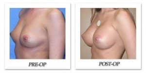 phoca_thumb_l_mandris-breast-augmentation-016