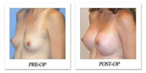 phoca_thumb_l_mandris-breast-augmentation-018