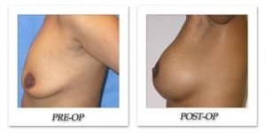 phoca_thumb_l_mandris-breast-augmentation-020