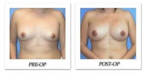 phoca_thumb_l_mandris-breast-augmentation-021