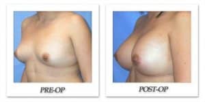 phoca_thumb_l_mandris-breast-augmentation-022