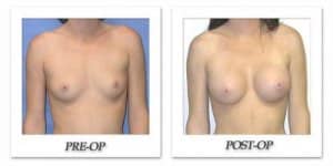 phoca_thumb_l_mandris-breast-augmentation-025