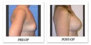 phoca_thumb_l_mandris-breast-augmentation-032
