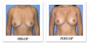 phoca_thumb_l_mandris-breast-augmentation-033