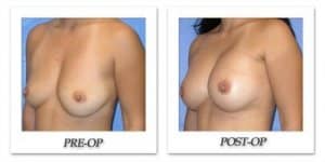 phoca_thumb_l_mandris-breast-augmentation-034