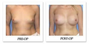 phoca_thumb_l_mandris-breast-augmentation-035