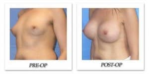 phoca_thumb_l_mandris-breast-augmentation-036