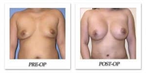 phoca_thumb_l_mandris-breast-augmentation-037