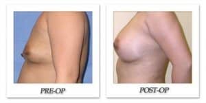 phoca_thumb_l_mandris-breast-augmentation-038