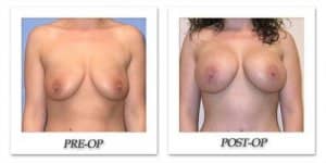 phoca_thumb_l_mandris-breast-augmentation-039