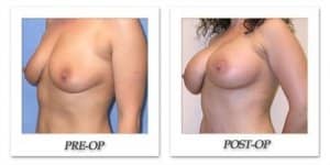 phoca_thumb_l_mandris-breast-augmentation-040