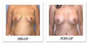 phoca_thumb_l_mandris-breast-augmentation-041