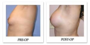 phoca_thumb_l_mandris-breast-augmentation-042