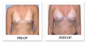 phoca_thumb_l_mandris-breast-augmentation-043