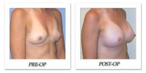 phoca_thumb_l_mandris-breast-augmentation-044