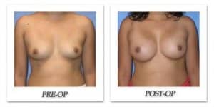 phoca_thumb_l_mandris-breast-augmentation-045
