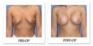 phoca_thumb_l_mandris-breast-augmentation-047