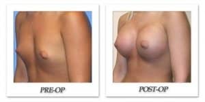 phoca_thumb_l_mandris-breast-augmentation-052