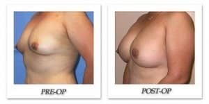 phoca_thumb_l_mandris-breast-augmentation-054