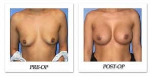 phoca_thumb_l_mandris-breast-augmentation-055