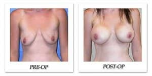 phoca_thumb_l_mandris-breast-augmentation-059