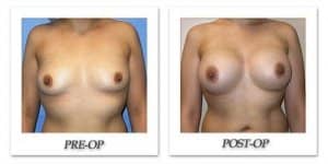 phoca_thumb_l_mandris-breast-augmentation-065