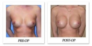 phoca_thumb_l_mandris-breast-augmentation-067