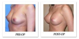 phoca_thumb_l_mandris-breast-augmentation-068