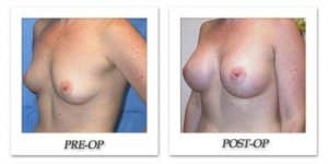 phoca_thumb_l_mandris-breast-augmentation-070