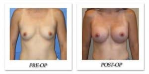 phoca_thumb_l_mandris-breast-augmentation-071