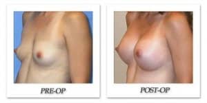 phoca_thumb_l_mandris-breast-augmentation-072