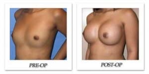 phoca_thumb_l_mandris-breast-augmentation-076