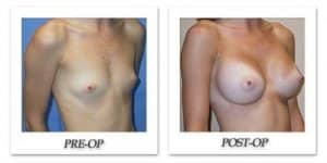 phoca_thumb_l_mandris-breast-augmentation-078