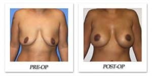 phoca_thumb_l_mandris-breast-augmentation-079