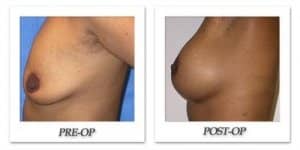 phoca_thumb_l_mandris-breast-augmentation-080