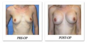 phoca_thumb_l_mandris-breast-augmentation-085
