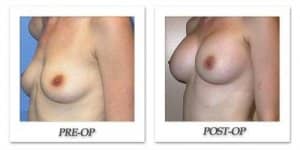 phoca_thumb_l_mandris-breast-augmentation-086
