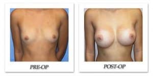 phoca_thumb_l_mandris-breast-augmentation-087