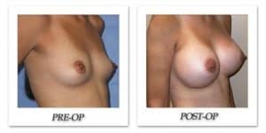 phoca_thumb_l_mandris-breast-augmentation-090