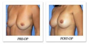 phoca_thumb_l_mandris-breast-augmentation-092